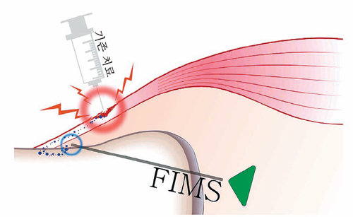 아픈 부위에 직접 염증을 없애는 기존 방법은 퇴화를 촉진하지만 FIMS는 오히려 염증을 통해 재생을 유도한다.