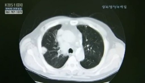 한국인 폐암 유형 1위