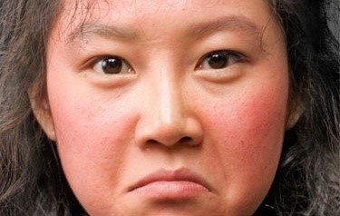 안면홍조 예방법