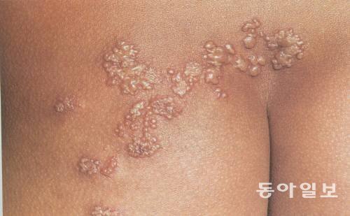 여성 대상포진 환자 증가. 사진=동아일보DB