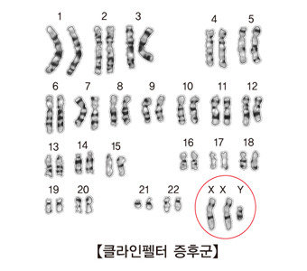 母子 사망' 클라인펠터증후군, 남아 1000명당 1명꼴…클라인펠터증후군이란?｜동아일보