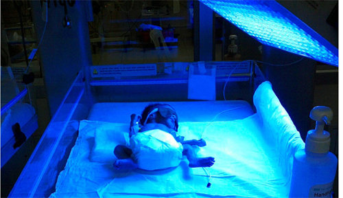 신생아에게 파란색 발광다이오드(LED) 빛을 쪼였더니 절반에서 황달이 사라지는 것으로 나타나는 등 광 치료의 효과가 드러나고 있다. 사진 출처 위키피디아