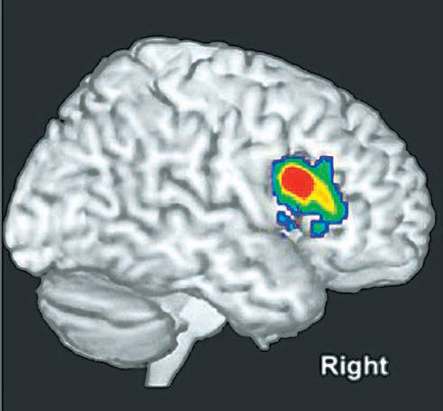 난독증에 관여하는 뇌 부위는 전두엽 하이랑(붉은색)으로 이 부위가 활성화될수록 난독증을 치료하기 쉬운 것으로 나타났다. 사진 출처 뉴런