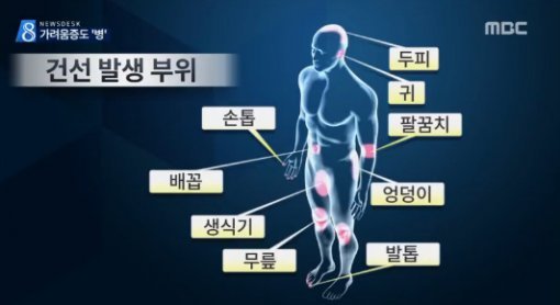 중년 남성 건선 주의 (출처=MBC)