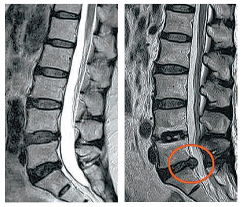 정상인 디스크(왼쪽)와 디스크가 신경을 누르고 있는 급성 허리디스크환자의 디스크(오른쪽) MRI 비교. 제일정형외과병원 제공