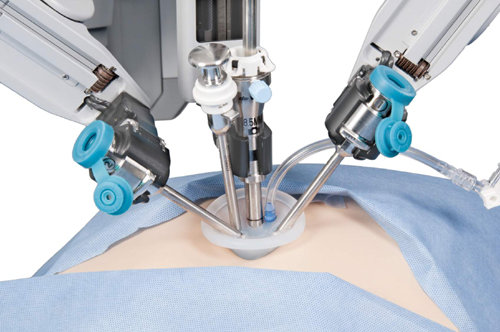 다빈치의 싱글포트 로봇팔이 환자의 몸에 장착된 모습. 인튜이티브서지컬 제공
