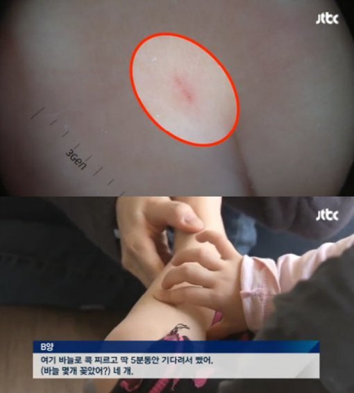 어린이집 이번엔 바늘 학대. 사진=JTBC 보도화면