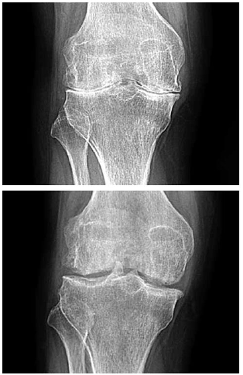 퇴행성관절염 환자 강모 씨의 줄기세포 수술 전후 X선 사진. 수술 전에는 연골이 거의 없어 무릎 뼈와 뼈 사이가 붙어있지만(위), 수술을 받고 1년이 지난 시점에는 연골이 재생돼 뼈와 뼈 사이가 검은색으로 보인다(아래).