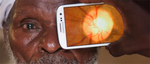 스마트폰 앱 ‘피크비전’을 실행한 뒤 카메라로 눈을 촬영하면 백내장까지 간편하게 진단할 수 있다. 피크비전 제공