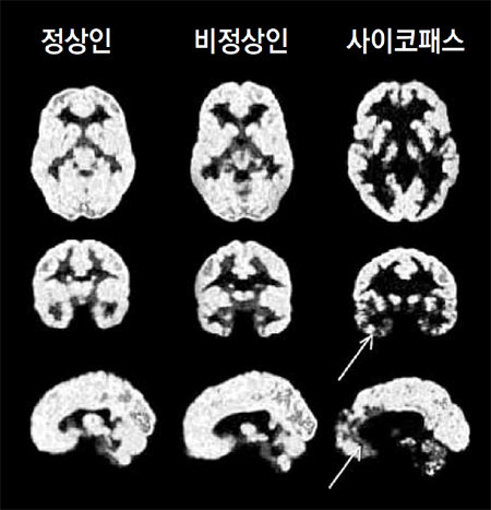 정상인과 비정상인, 사이코패스의 뇌를 양전자단층촬영(PET)한 사진. 사이코패스의 뇌는 사회적 행동, 도덕성에 관여하는 안와피질(화살표)이 어둡게 나타난다. 이것은 해당 부위가 제대로 활성화되지 않아 제 역할을 하지 못함을 뜻한다. 더퀘스트 제공