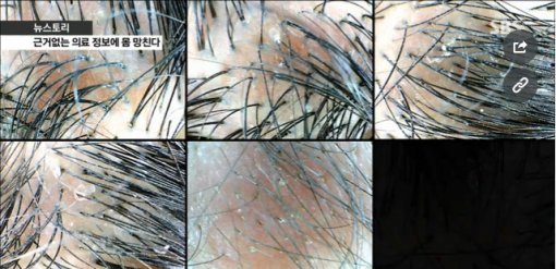 노푸 열풍이란 참가자의 두피상황. 전문의는 오히려 탈모가 촉진될 수 있다고 우려했다(출처=SBS영상 갈무리)