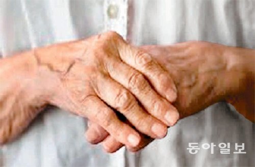 류머티스 관절염을 앓고 있는 환자의 손 모습. 염증으로 인해 양쪽 손가락 관절이 붓고 통증이 생길 수 있다. 동아일보DB