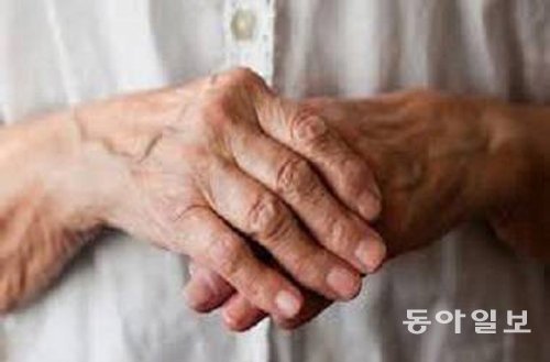 류머티스 관절염을 앓고 있는 환자의 손 모습. 염증으로 인해 양쪽 손가락 관절이 붓고 통증이 생길 수 있다. 동아일보DB