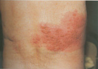 젊은 층 대상포진 빈발. 사진=동아일보 DB