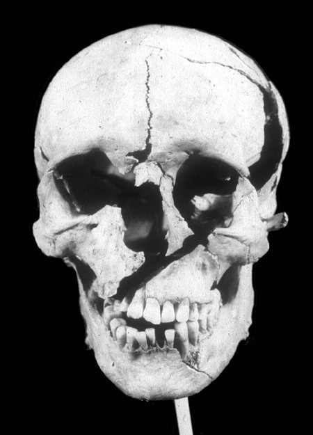 1461년 잉글랜드 내전 당시 적군의 공격을 받아 얼굴이 반으로 갈라진 병사의 두개골. 저자는 세월을 거슬러 올라갈수록 폭력에 의한 희생자의 인구 비율이 높아진다고 설명한다.