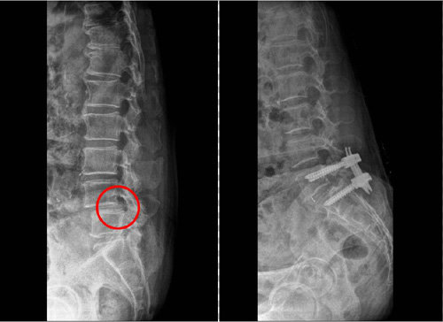 디스크가 협착된 척추뼈(왼쪽 사진)를 최소침습적 경피적 척추유합술로 수술한 모습(오른쪽 사진). 제일정형외과병원 제공