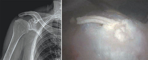 석회화건염 환자의 엑스레이 사진. 어깨의 힘줄, 근육, 인대 주변에 석회가 쌓여 통증을 유발하는 질환이다.