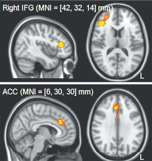 뇌가 활성화되는 부위를 찍을 수 있는 기능성 자기공명영상(fMRI)으로 게임경험군의 뇌(사진)를 찍었다. 실험을 하는 동안 게임경험군이 비경험자에 비해 고위 인지 기능을 담당하는 앞쪽 뇌가 더 많이 활성화(반짝이는 부분)된다는 것이 확인됐다. 사진제공｜강동화 교수