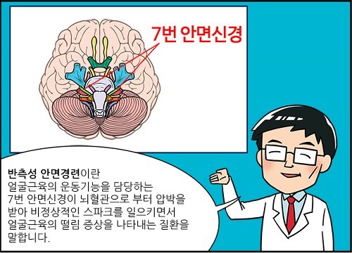 파르르 떨리는 눈 밑 '반측성 안면경련' 미세혈관감압술로 치료｜동아일보