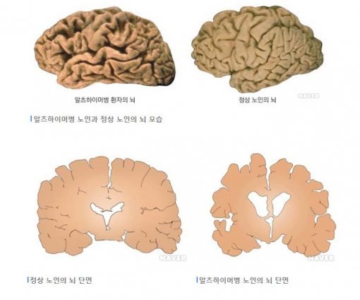 알츠하이머 걸린 사람의 뇌. 사진= 네이버 건강백과