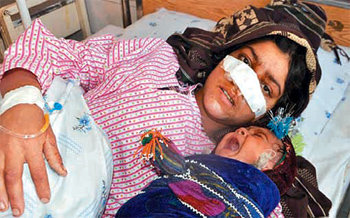 남편에게 코가 잘려 병원으로 실려 온 아프가니스탄 여성 레자 굴(20)이 딸과 함께 병상에 누워 있다. AFP통신