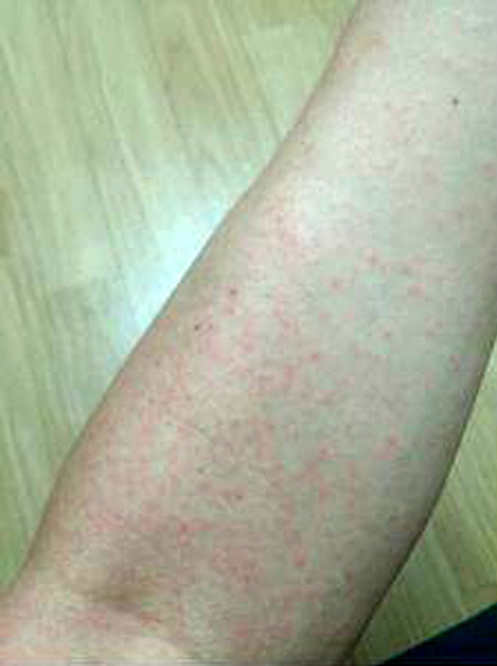 한국인 첫 지카 바이러스 감염자인 A 씨의 팔에 나타난 발진 모습. 보건당국은 비슷한 증상이 있을 경우 전화 109번으로 신고해 달라고 당부했다. 질병관리본부 제공