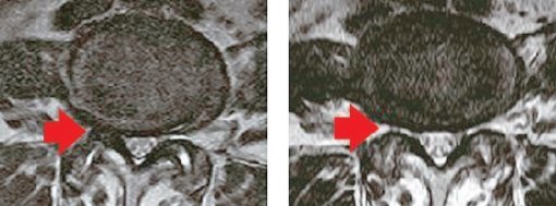 원리침을 이용해 척추관 협착증을 치료한 환자의 자기공명영상(MRI) 사진. 막혀있던 척추관(왼쪽 사진)이 뚫린 것(오른쪽 사진)을 확인할 수 있다.