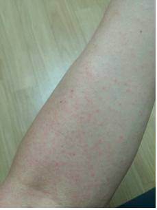 한국인 첫 지카 바이러스 감염자의 팔에 나타난 발진 모습. 보건당국은 비슷한 증상이 있을 경우 전화 109번으로 신고해 달라고 당부했다. 질병관리본부 제공
