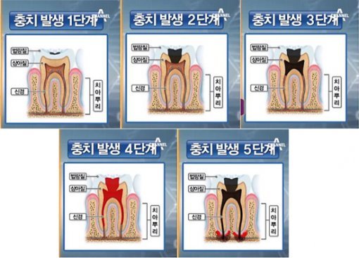 1단계 : 치아의 법랑질 표면에 까만 점이 생기면 충치의 시작점이 생긴 것이다. 법랑질에는 신경세포가 없어서 통증이 나타나지 않는다. 양치질을 잘하면 구멍이 뚫리지 않은 이상 치료를 하지 않아도 그 상태가 유지된다. 2단계: 충치가 법랑질을 뚫고 상아질까지 침투한 상태. 달거나 찬 음식을 먹으면 시린 통증이 느껴진다.3단계: 충치가 상아질을 지나 신경에 닿게 된다. 가만히 있어도 통증이 있다.   4단계: 충치가 모든 신경을 죽여서 통증이 사라진다.  5단계: 죽은 신경의 염증이 치아의 뿌리 꿑에 모이면서 잇몸뼈가 녹는다.