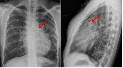 인공심장 판막이 폐동맥 판막 부위에 이식된 사진