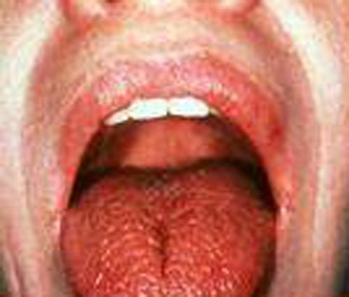 쇠그렌 증후군으로 혀가 말라 있는 환자의 모습.