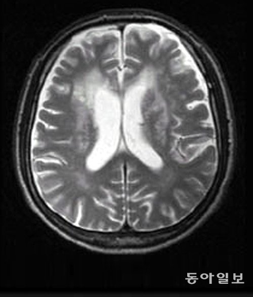 뇌경색으로 혈관성 치매에 걸려 뇌에 손상을 입은 환자의 MRI 사진. 동아일보DB