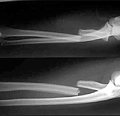 근위요골 골절을 당한 사례(오른쪽이 팔꿈치 쪽). 근위요골은 전완(팔꿈치부터 손목까지의 부분)에 있는 뼈의 팔꿈치 쪽 부분이다. 서울제이에스병원 제공