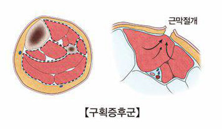 근육이 몇 개씩 한 덩어리를 이룬 ‘구획’ 내 염증이 생겨 주변부의 압력이 높아진 모습(왼쪽). 근막을 절개해 구획 내 압력을 감소시키는 수술(오른쪽)로 치료할 수 있다. 서울아산병원 제공