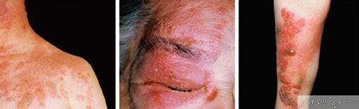 어깨, 안부, 팔뚝에 나타난 대상포진.