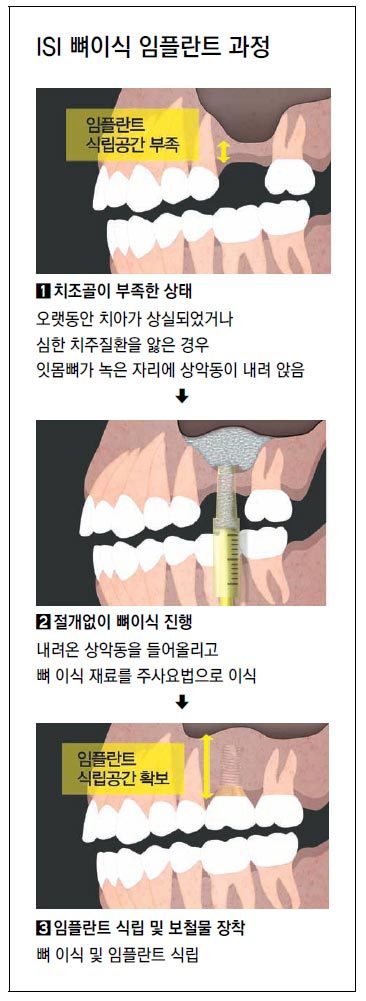 최소한의 치은 절개, 임플란트에 문제 없음 6