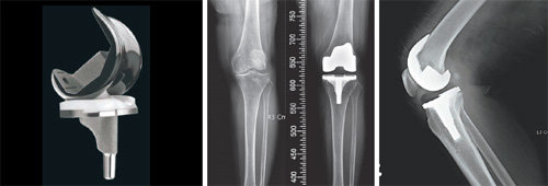 인공 무릎 관절 ‘베리라스트(VERILAST)’(왼쪽). 스미스앤드네퓨 제공 인공관절 수술 전후 모습(가운데). 인공관절 수술 후 모습. 이춘택병원 제공