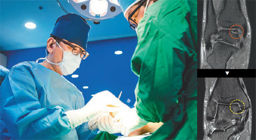 전문적 족부치료를 위해 출범한 연세건우병원 족부톱팀은 족부 내시경 수술의 성공적 안착을 이끌었다. 오른쪽 사진은 줄기세포 이용한 연골재생술 전과 후. 연세건우병원 제공