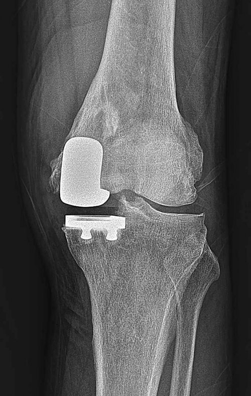 무릎 부분인공관절수술 사진.