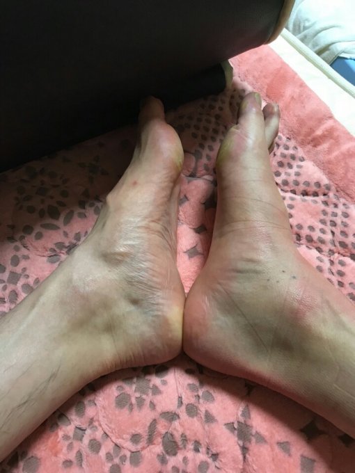부상 직후 김종규의 발목상태. 오른쪽이 부상당한 발목이다. 심하게 부어있는 것을 알 수 있다. 사진제공 | LG