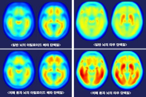 미국 워싱턴대 연구팀이 치매에 걸린 사람의 뇌(아래)와 걸리지 않은 사람의 뇌를 양전자방출단층촬영(PET)으로 촬영한 영상을 공개했다. 왼쪽은 아밀로이드 베타 단백질, 오른쪽은 신경세포 안의 타우 단백질을 측정한 영상이며 진한색일수록 양이 많은 것이다. 양쪽 모두 치매 환자에게서 많이 발견된다. 사진 출처 워싱턴대