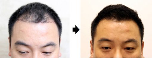 40대 남성 탈모증 환자가 모발이식 수술을 받기 전(왼쪽 사진)과 후의 모습. 모발이식 수술 후 3∼6개월부터는 이식된 모낭에서 머리카락이 자란다.
털털한피부과의원 제공
