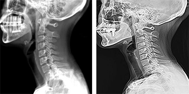 목 척추가 C자 형태인 정상 X레이 사진(왼쪽), 반면 오른쪽은 일자로 변형됐다. 일자목이 되면 목 부위뿐만 아니라 머리와 어깨에도 통증을 느낄 수 있다. 동아일보DB·국민건강보험공단 제공