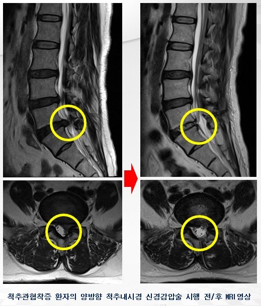 척추협착증 환자의 ‘양방향 척추내시경 신경감압술’ 시술 전후 MRI 영상.