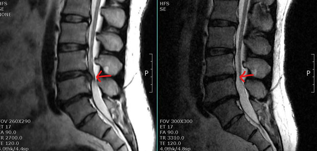 디스크 환자의 고주파 디스크 치료술 전(왼쪽 사진)과 후 병변 부위 MRI.