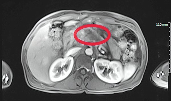 50대 췌장암 환자의 자기공명영상(MRI).