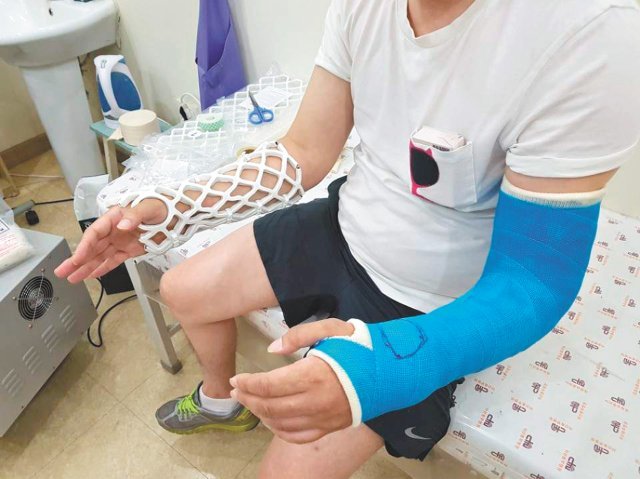 한 환자가 왼팔엔 플라스틱 캐스트를 오른팔엔 오픈캐스트를 착용해 치료받고 있다.