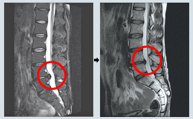 신경이 누르고 있던 4-5번 디스크가 원리침 치료를 통해 완화된 박영옥 씨의 자기공명영상(MRI).