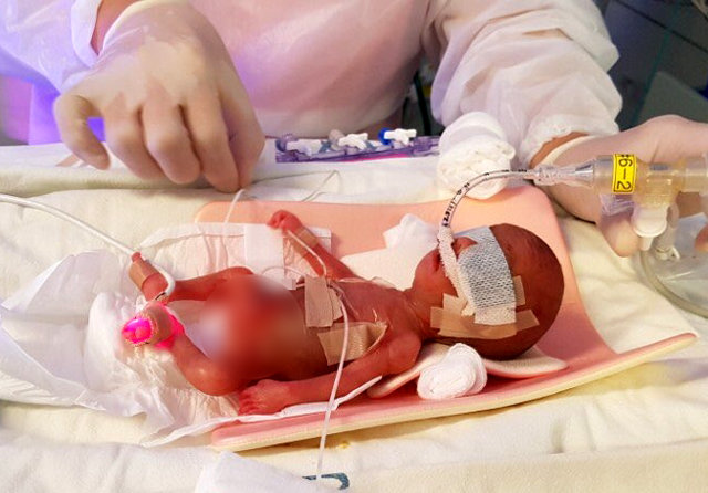 태어난 지 이틀된 손바닥만 한 크기의 사랑이가 인큐베이터에서 치료를 받고 있다. 서울아산병원제공