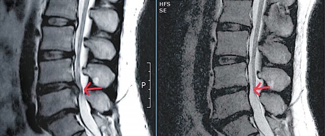 40대 후반 남성의 디스크 치료 전후 X선 사진. 척추간 4∼5번 추간판탈출증 진단을 받을 당시(왼쪽)와 하이브리드 고주파 디스크 치료술을 받은 뒤의 상태로, 튀어나왔던 디스크가 제자리를 찾은 것을 확인할 수 있다.